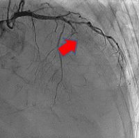 経皮的冠動脈インターベンション術前