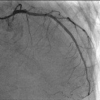 経皮的冠動脈インターベンション術後