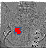 経皮的末梢動脈形成術前
