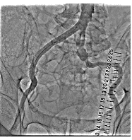 経皮的末梢動脈形成術後