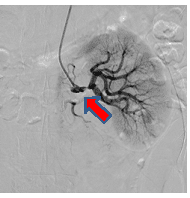 経皮的腎動脈形成術前