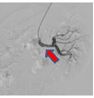 経皮的腎動脈形成術後