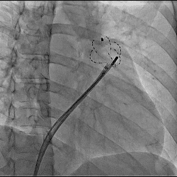 多発性心室性期外収縮に対して
