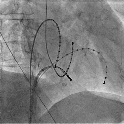 発作性心房粗動に対して