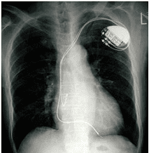 ペースメーカー移植術2