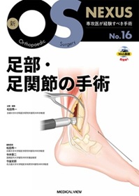 外反母趾に対する手術療法。近位骨切り術