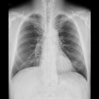 胸部X線検査（正面）