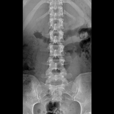 腰椎X線検査（正面）