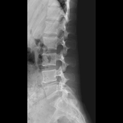 腰椎X線検査（側面）