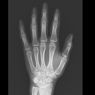 手部X線検査（正面）