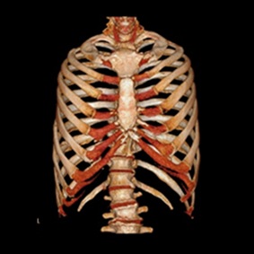 肋骨（3D画像）