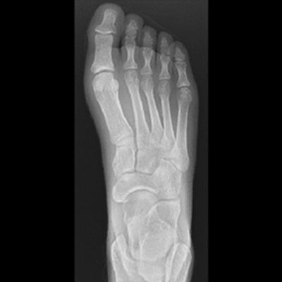 足部X線検査（正面）