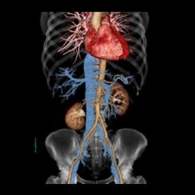 腹部臓器（3D画像）