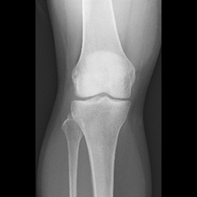  膝関節（正面）